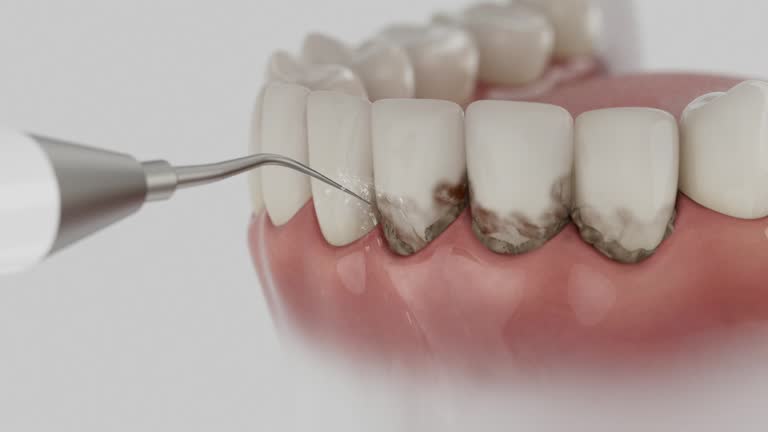 Reliable Tooth Extraction contractor in Mentone, CA by Smile Center Dentistry